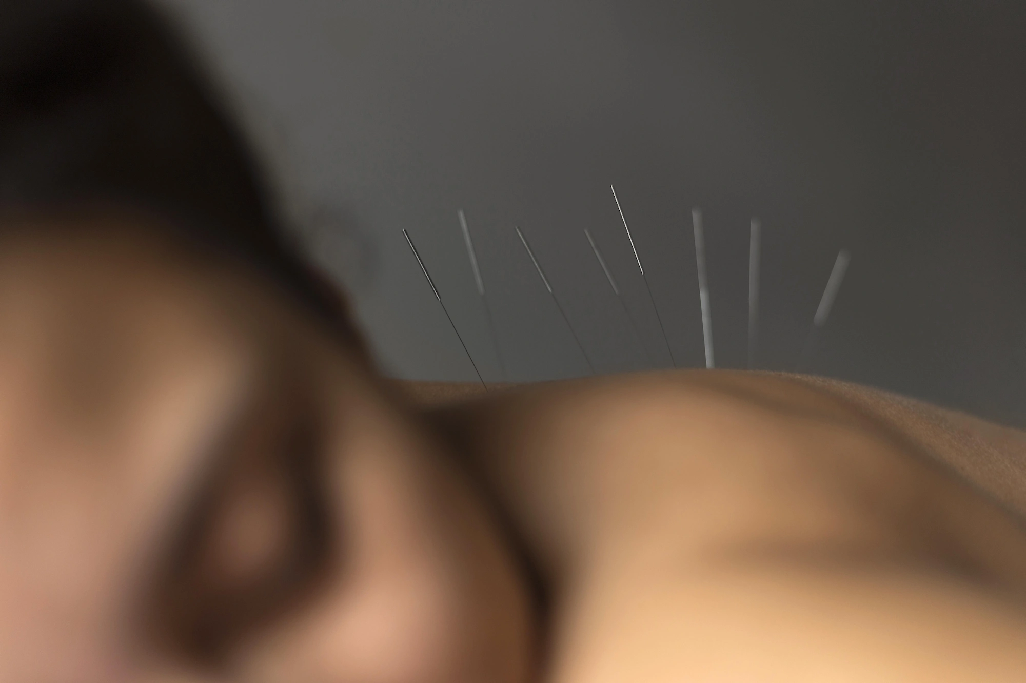 Dry Needling / Medical Acupuncture Coburg